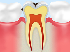 C1 エナメル質が変色するむし歯